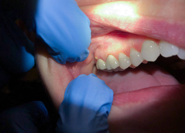 Best Emergency Tooth Extraction in Nassau Bay, TX